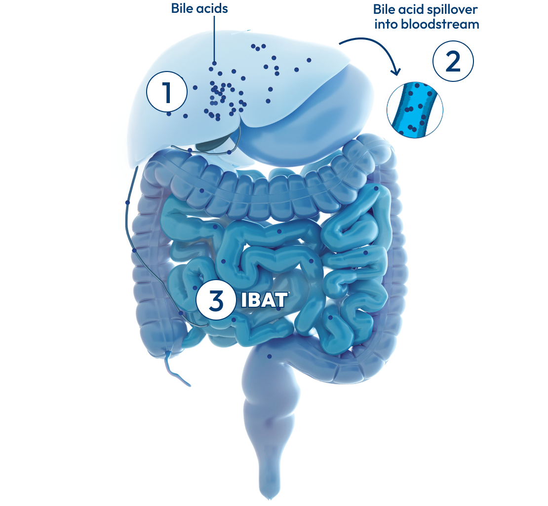 Liver with intestines, with a number 1 showing bile acids and bile ducts, a number 2 showing bile acid spillover, and a number 3 showing IBAT.