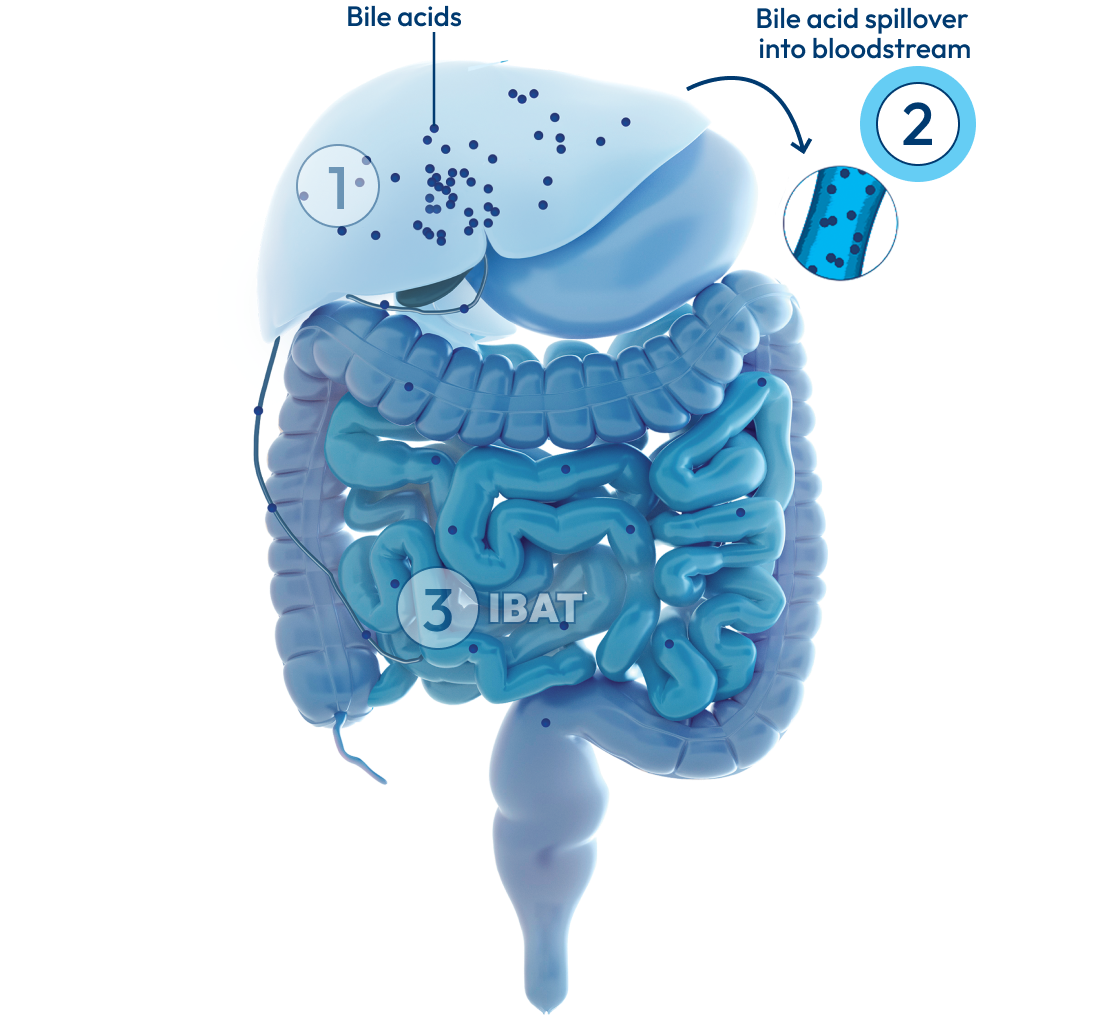 Graphic of the liver and intestines, with a number 2 representing bile acid spillover.