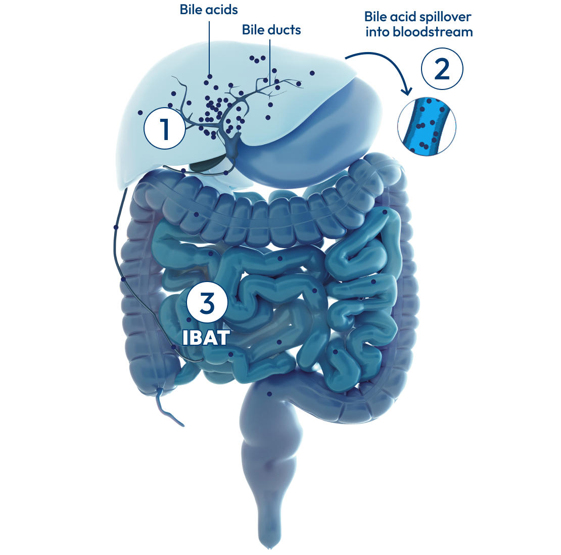 Liver and intestines, with a number 1 showing bile acids and bile ducts, a number 2 showing bile acid spillover, and a number 3 showing IBAT.
